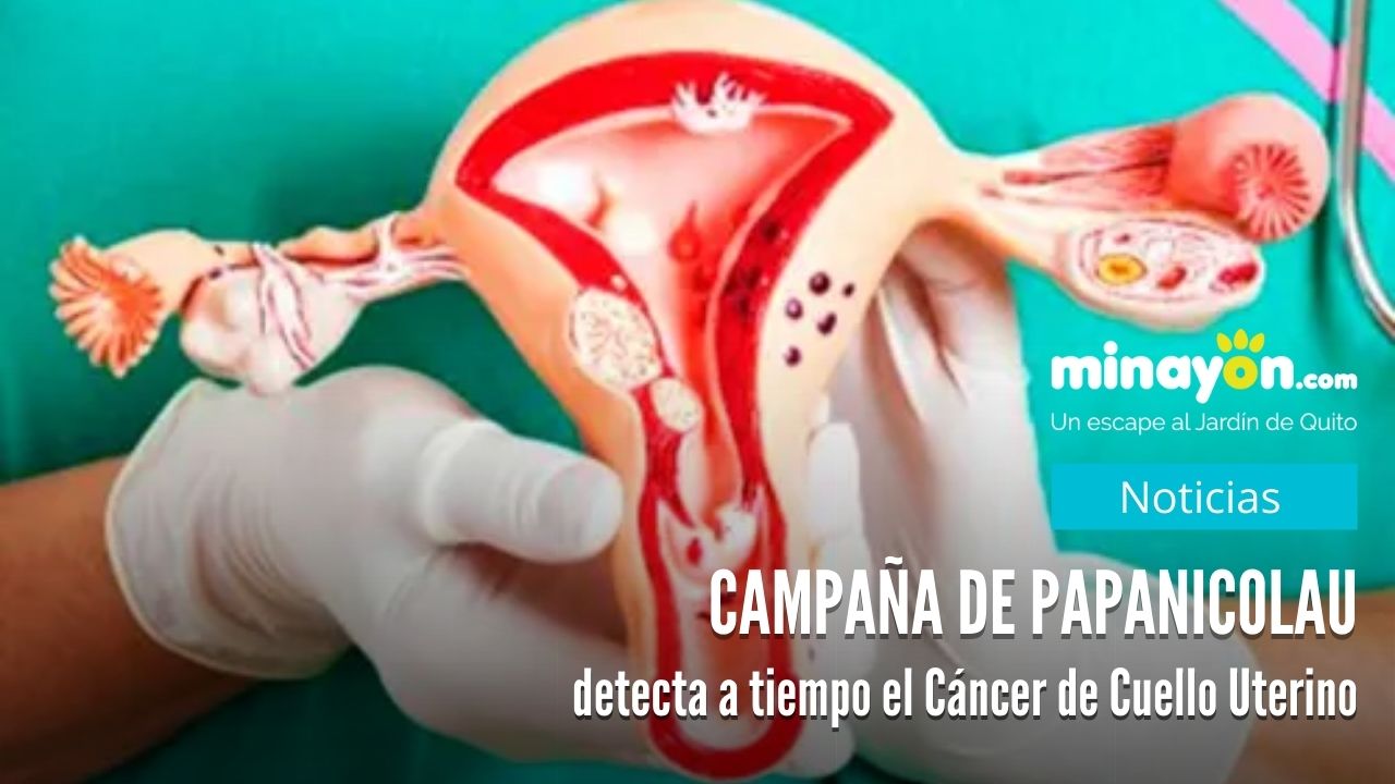 Campaña de Papanicolau, detecta a tiempo el Cáncer de Cuello Uterino